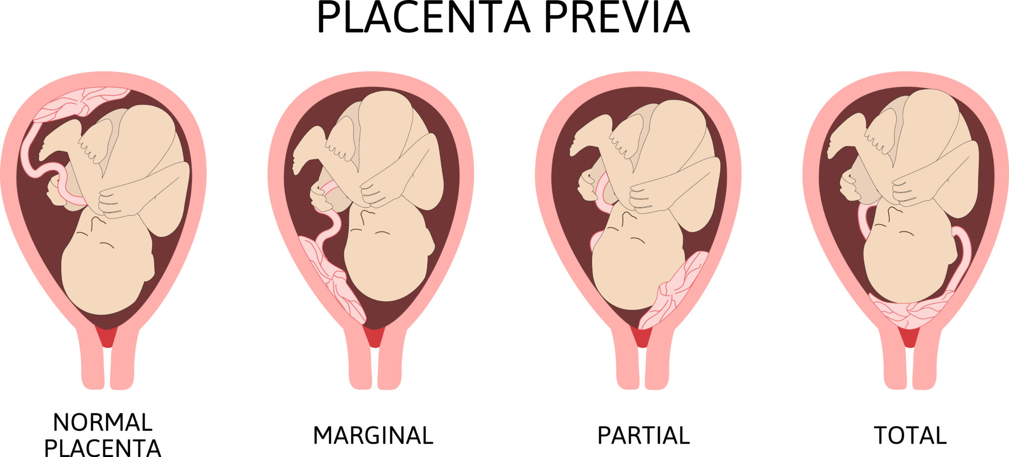 Плацента при переношенной беременности